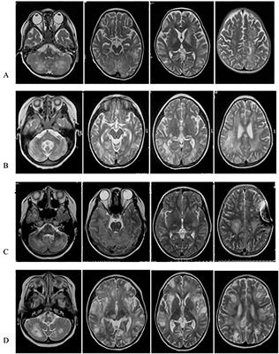 Neurologic Manifestations as Initial Clinical Presentation of Familial Hemophagocytic Lymphohistiocytosis Type2 Due to PRF1 Mutation in Chinese Pediatric Patients